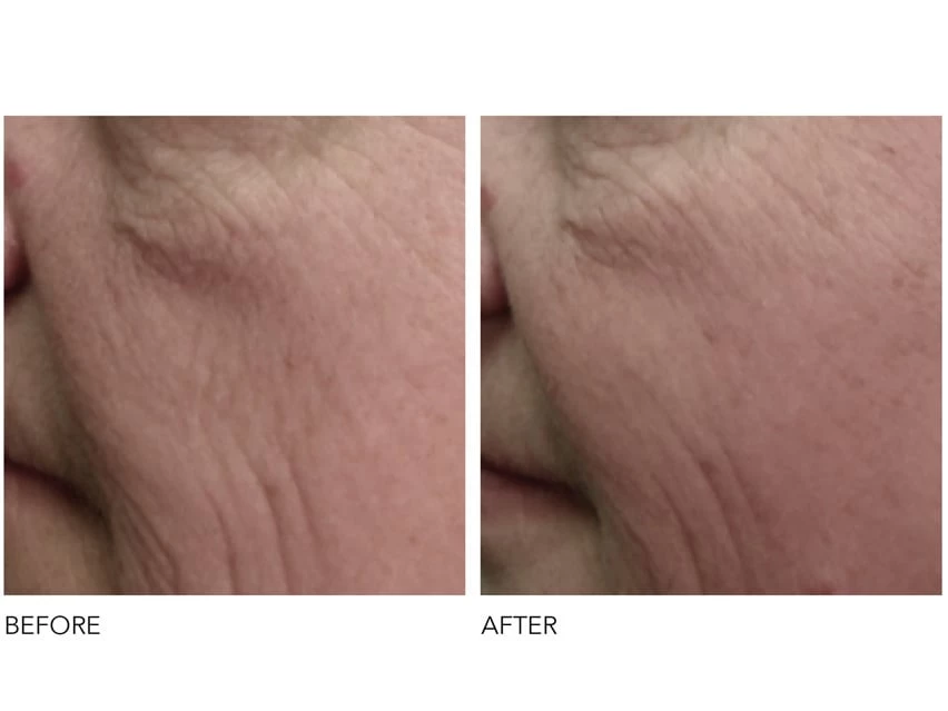 Dr. Dennis Gross Skincare DRx SpectraLite™ FaceWare Pro 5 Dr. Dennis Gross Skincare DRx SpectraLite™ FaceWare Pro - Image 5