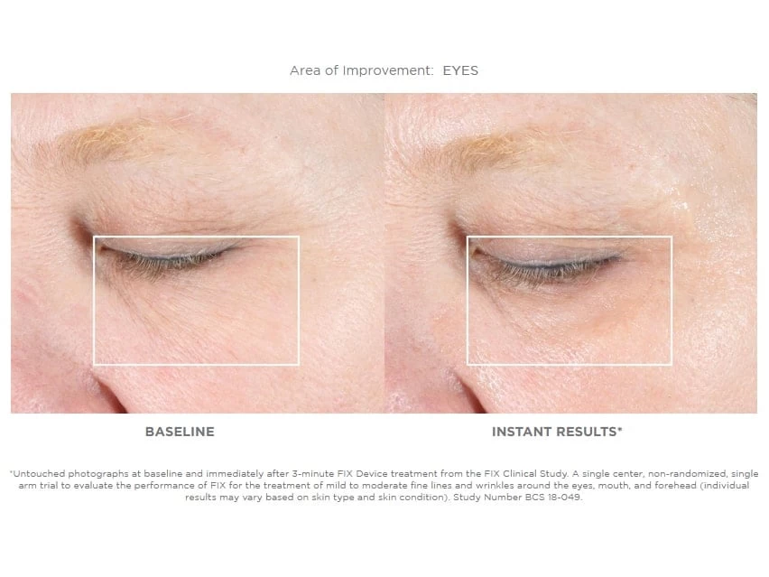 NuFACE FIX Starter Set 2 NuFACE FIX Starter Set - Image 2