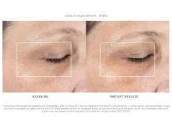 NuFACE FIX Starter Set 13 NuFACE FIX Starter Set -Classic Skin Care Product Store 4wwer1yo 201902041814305752