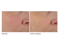 Dr. Dennis Gross Skincare Advanced Retinol + Ferulic Overnight Texture Renewal Peel -Classic Skin Care Product Store 5fl1mgii 202108121304467282