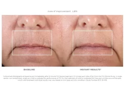 NuFACE FIX Starter Set 12 NuFACE FIX Starter Set -Classic Skin Care Product Store bagimkry 201902041814139032