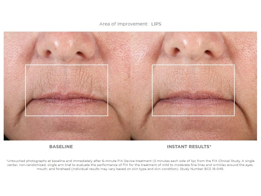 NuFACE FIX Starter Set 3 NuFACE FIX Starter Set - Image 3