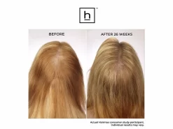 HairMax LaserBand 41 ComfortFlex Hair Growth Device -Classic Skin Care Product Store eij2hlev 202211091901188807