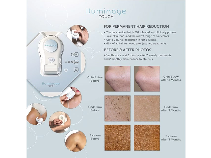 Iluminage Touch 4Ever Home Permanent Hair Removal IPL & Radio Frequency System 7 Iluminage Touch 4Ever Home Permanent Hair Removal IPL & Radio Frequency System - Image 7