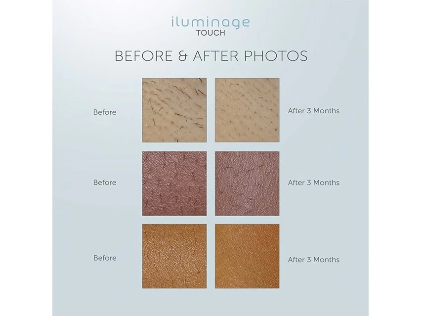 Iluminage Touch 4Ever Home Permanent Hair Removal IPL & Radio Frequency System 13 Iluminage Touch 4Ever Home Permanent Hair Removal IPL & Radio Frequency System - Image 13