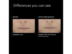 PCA SKIN BPO 5% Cleanser -Classic Skin Care Product Store now5fwb1 202303211356479111