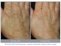 Jan Marini ReNu Corrective Hand Complex 8 Jan Marini ReNu Corrective Hand Complex -Classic Skin Care Product Store oigz5hwm 201809111634169450