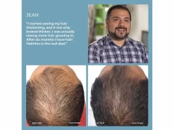 HairMax Ultima 9 Classic LaserComb Hair Growth Device -Classic Skin Care Product Store rb0uglii 202211092051304596